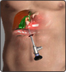 Gall Bladder Surgery - Mr Jim S Khan - Consultant Laparoscopic, Colorectal & General Surgeon