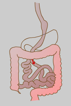 Gastric Roux-En-Y Bypass, Havant Hampshire