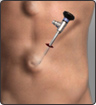 Laparoscopic Hernia surgery - Mr Jim S Khan - Consultant Laparoscopic, Colorectal  General Surgeon