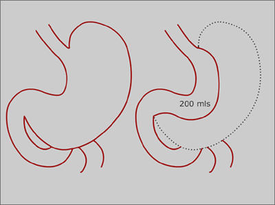 Tube Gastrectomy or Gastroplasty